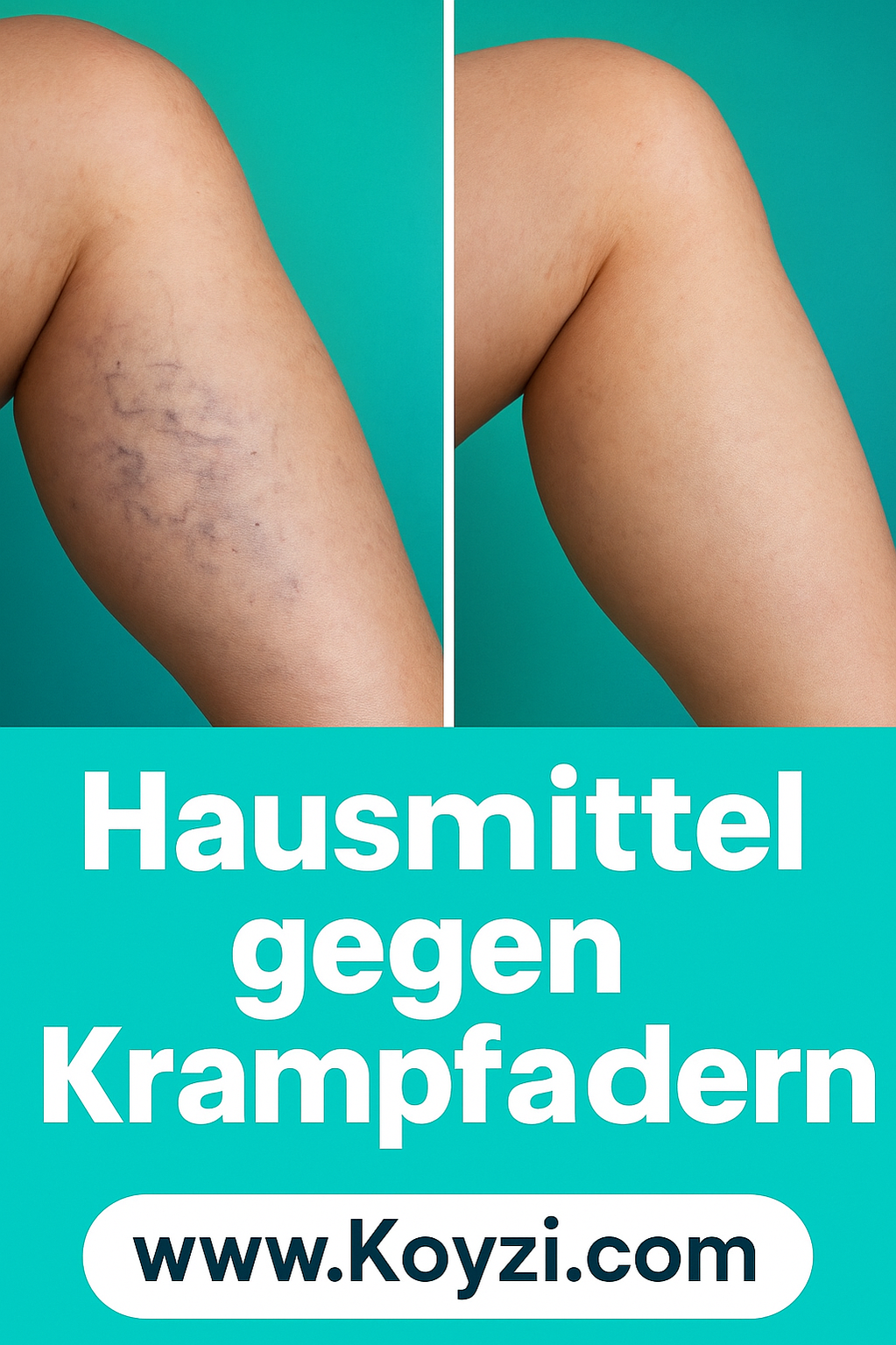 Natürliche Hausmittel gegen Krampfadern